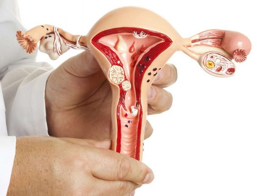 U xơ tử cung thường gặp ở phụ nữ trong độ tuổi sinh sản từ 30-35 tuổi